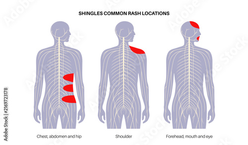 Naklejka Silhouettes rash distribution comparison