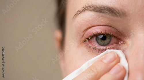 Woman wiping a teary eye with a tissue. Close-up portrait expressing sadness, emotional distress, grief, vulnerability, and personal care concept for mental health awareness.