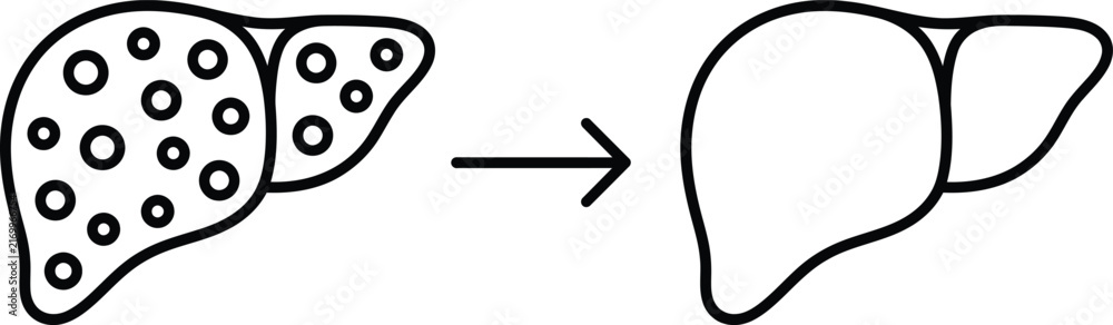 Fototapeta premium Medical vector illustration of a polycystic liver disease transitioning into a healthy organ after treatment