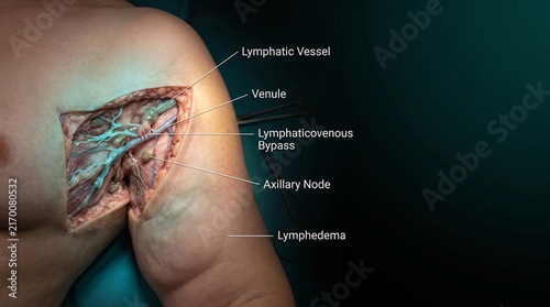 Medical illustration of lymphatic vessel and lymphovenous bypass in human arm and axillary region