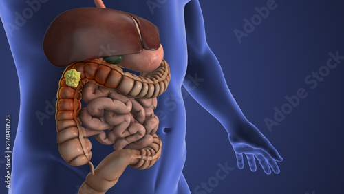 Obraz na płótnie Colon Polyp Developing Inside the Large Intestine