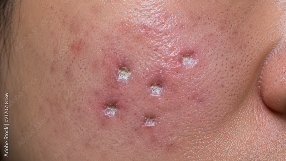 Naklejka premium Close-up of inflamed skin with multiple pustules and acne lesions on human cheek
