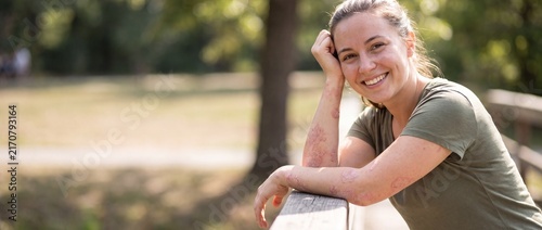 A portrait of a smiling, confident young woman resting her arms on a wooden railing in a sunny park, openly showing red psoriasis plaques on her skin.