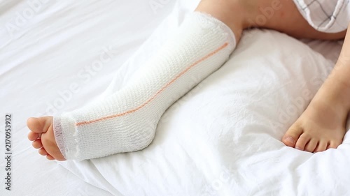 Children's broken leg in orthopedic cast on a white bed in the . Broken leg in cast of an young child