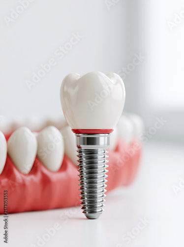 A close-up view of a dental implant placed on a model of human teeth, showcasing modern dental technology.