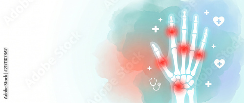 Hand bone xray with red joint pain indicators highlighting inflammation. This graphic is used for educational healthcare content and awareness during International Day of Radiology.