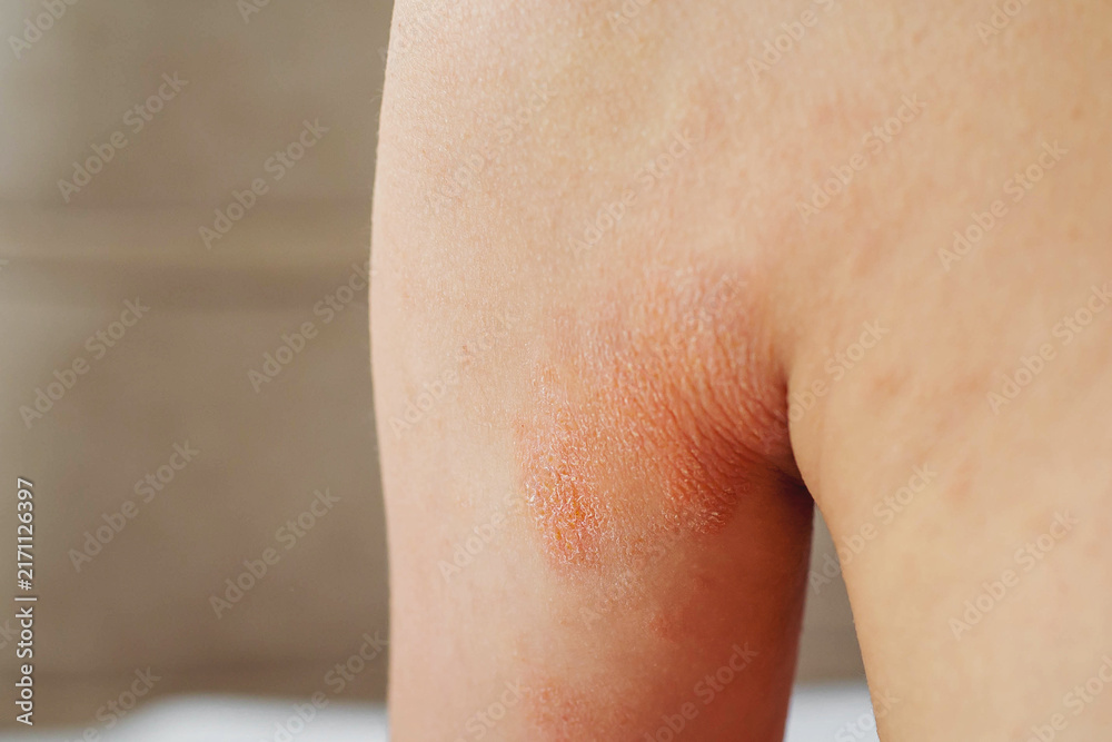 Fototapeta premium Close-up of dry irritated skin with redness, scaly texture in body fold, illustrating dermatology, skincare, allergy, inflammation concepts for medical healthcare education