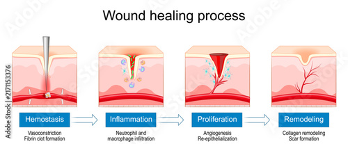 Wound healing process. Hemostasis, Inflammation, Proliferation and Remodeling skin epithelium. Stages of tissue repair and skin regeneration