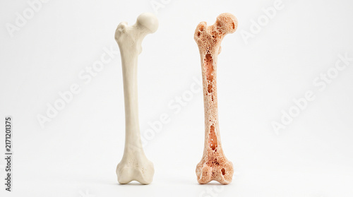 Healthy dense femur bone beside osteoporotic porous bone, showing bone density loss and osteoporosis comparison