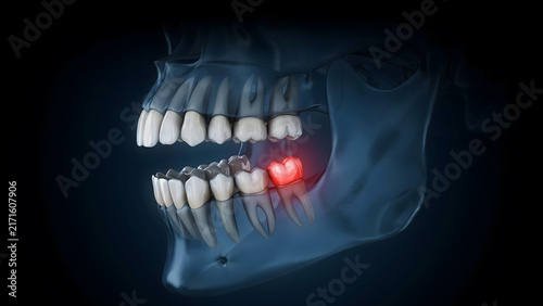 Medical illustration of a human jaw with an inflamed and painful tooth