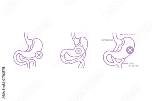 Gastric bypass surgery procedure medical diagrams