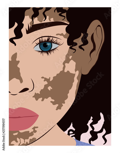 Woman with vitiligo half face portrait