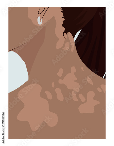Woman with vitiligo neck detail portrait