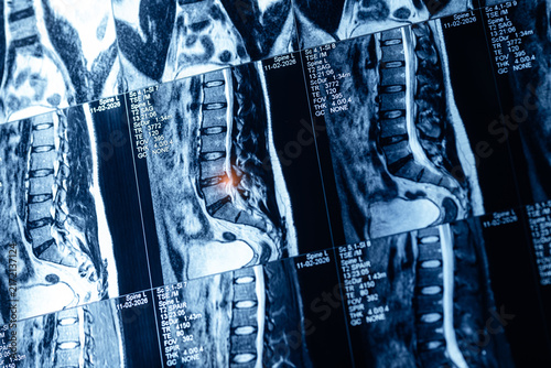 Bild auf Leinwand Multiple mri lumbar spine scan series of man adult for medical diagnostic backgr