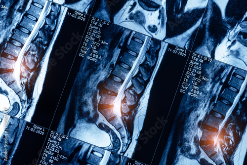 Fotografie Mri scan with sunlight of spine showing disc protrusion in vertebral column, pin