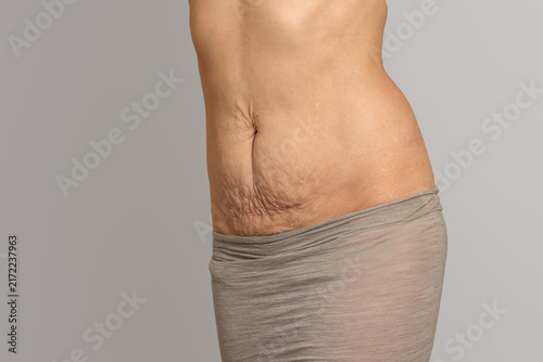Fotografía Woman postpartum belly with loose skin and stretch marks after pregnancy