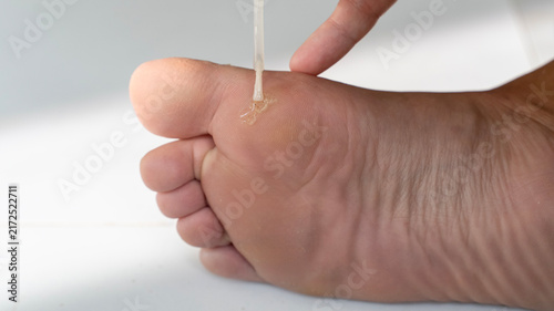 Canvastavla Applying Liquid Treatment to a Plantar Wart on the Foot