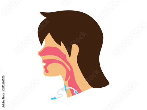 Tracheostomy Tube or Throat Cancer Airway