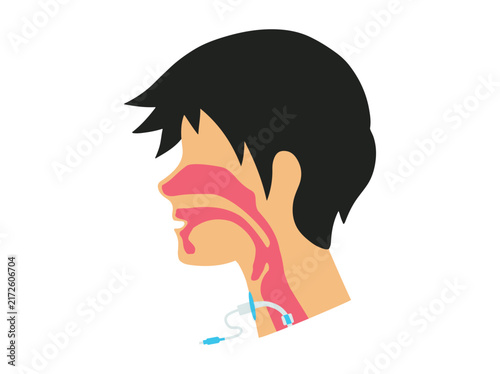 Tracheostomy Tube or Throat Cancer Airway