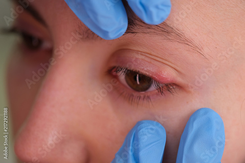 Bild auf Leinwand A close-up view of an eye examination in a professional medical setting, where a person wearing blue gloves carefully inspects the eye, emphasizing the clinical and healthcare environment