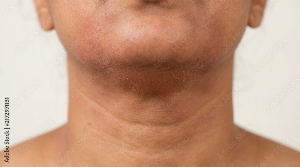 Naklejka premium Close up of a man with a visible surgical scar on his neck