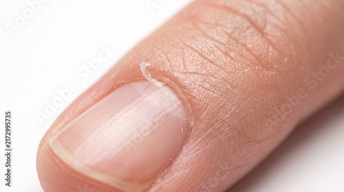 Extreme Macro of Painful Peeling Hangnail Cuticle Tear on Human Fingernail Edge