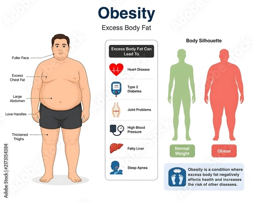 Obesity Health Concept with Excess Body Fat Medical Illustration