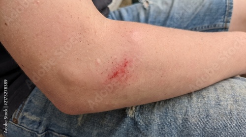 Close up view of a red mark on the human forearm skin showing a painful wound and redness on the flesh