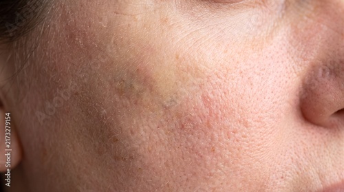 Close up view of facial skin texture and redness showing skin imperfections and natural complexion details