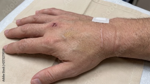 Close up view of hand and forearm showing medical markings and skin examination details during a procedure