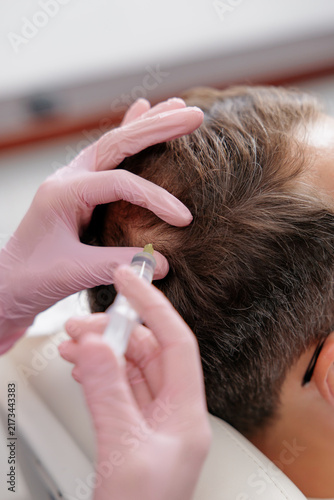 Closeup scalp injection hair restoration treatment for men in clinic for medical trichologist