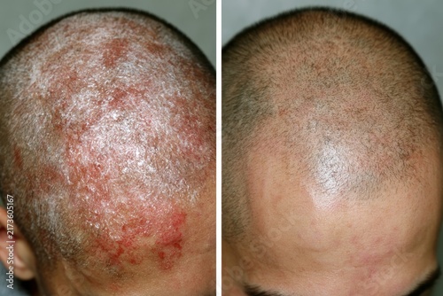 Scalp condition before and after treatment showing redness and flaking then clear skin