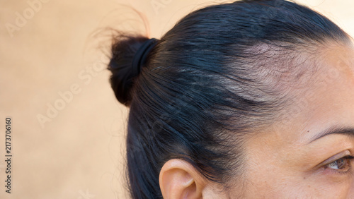 Traction Alopecia from Tight Ponytail with Frontal Hairline Thinning