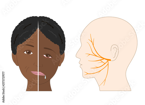 Facial Asymmetry and Facial Nerve Pathway in Facial Nerve Palsy – Anatomical Illustration