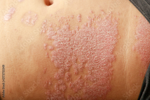 Fotografie Close-up of a chronic scaly skin condition on the human abdomen with inflamed pl