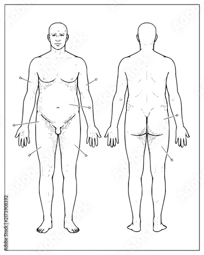 Medical diagram of male body showing fat distribution and anatomical marking points front and back