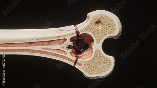 Bone Cancer: Malignant Tumor Lesion of Human Bone Tissue, 3D Medical Anatomical Illustration of Skeletal System Organ