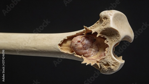 Bone Cancer: Malignant Tumor Lesion of Human Bone Tissue, 3D Medical Anatomical Illustration of Skeletal System Organ