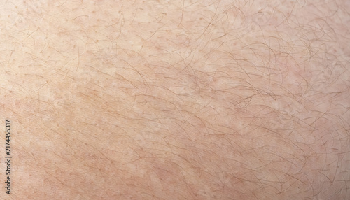 Fotografie Scars from stretch marks, striae on skin texture closeup