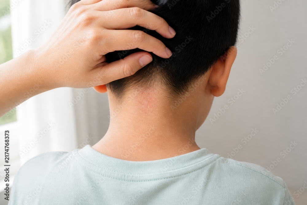 Fototapeta premium Caregiver examining heat rash on child's neck