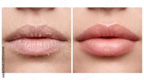 dry chapped lips treatment before and after | lip hydration skincare results comparison | healing peeling skin on lips macro photography | cosmetic lip filler effect and moisturizing balm