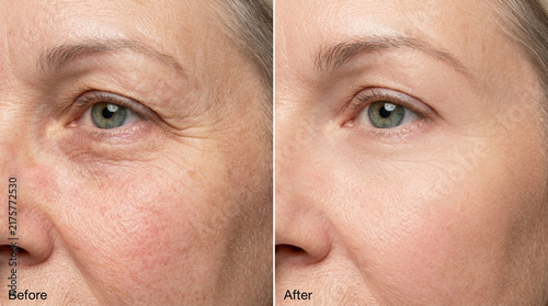 Mature Woman's Skin Before and After Anti-Aging Treatment Comparison