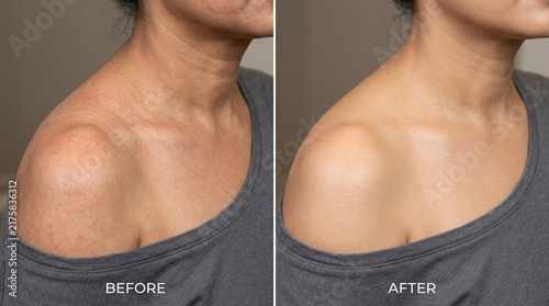 Skin care comparison: Before and after showing improvement in texture and tone
