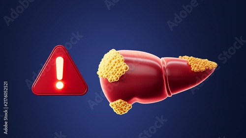 Human fatty liver, liver diseases, hepatitis, etc. anatomical models. 3d rendering.