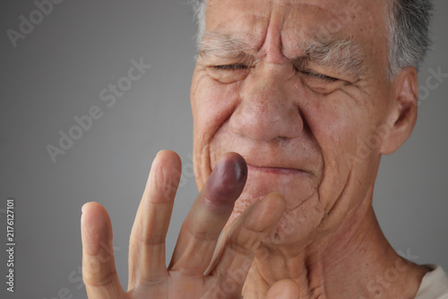 Senior Man with a Badly Bruised Middle Finger 