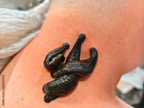 Fotografie Medicinal leeches performing hirudotherapy treatment on a person's neck, a traditional alternative medicine involving bloodsucking worms for therapeutic purposes