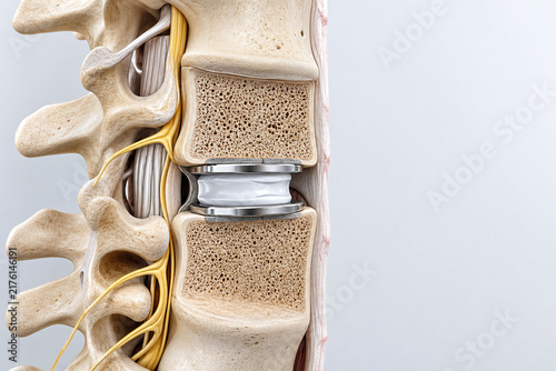 Obraz na płótnie Artificial disc replacement preserving spinal motion cutaway