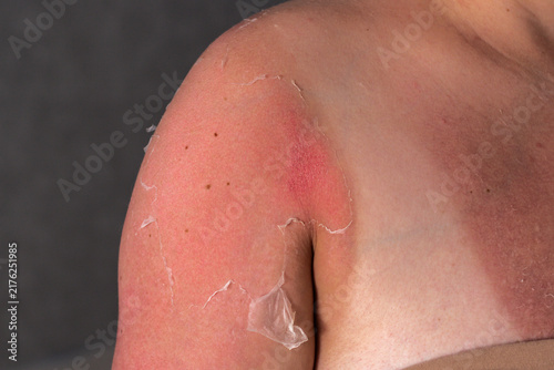 Принти на полотні Woman with peeling shoulders from excessive sun
