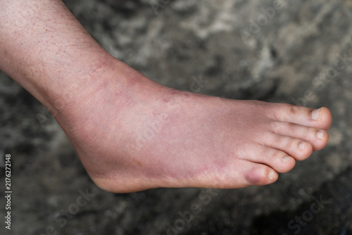 Bild auf Leinwand Swollen Foot After Cast Removal of Metatarsal Fracture