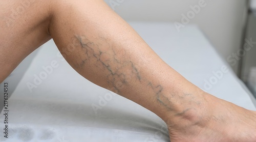 Close up view of leg skin showing spider veins and visible superficial venous condition.